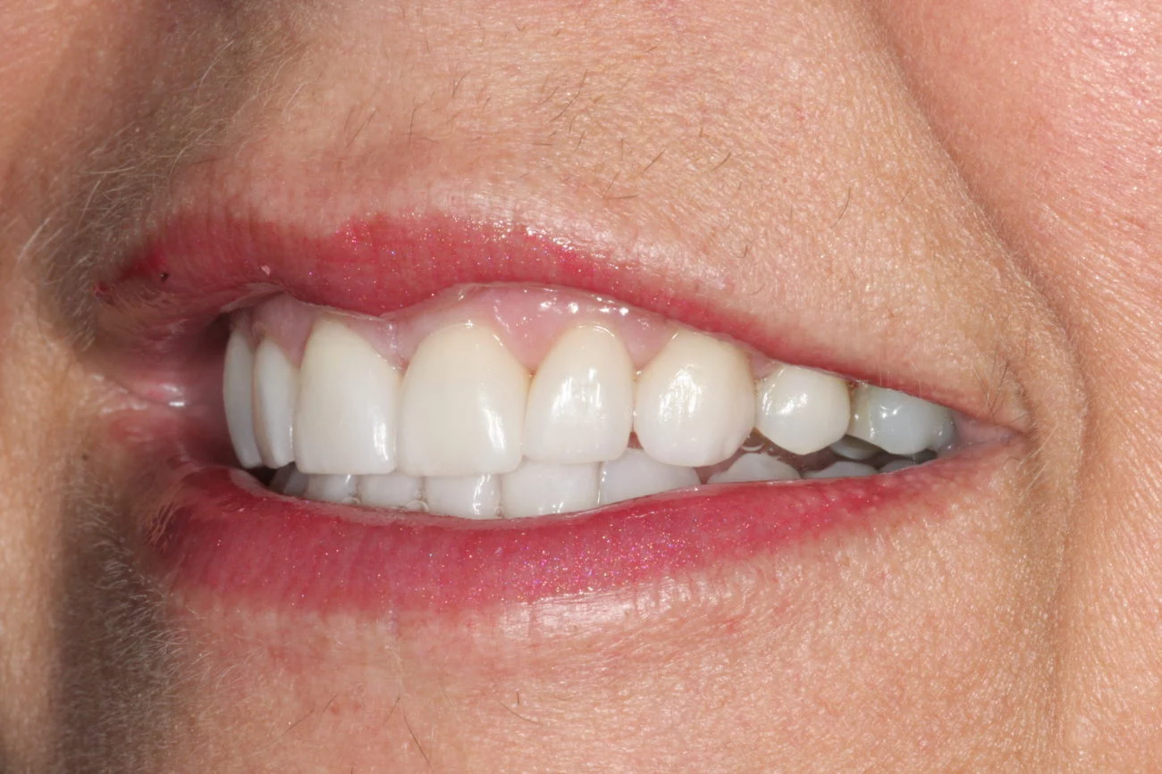 Teeth Whitening in Virginia Beach, VA Cosmetic Dentistry