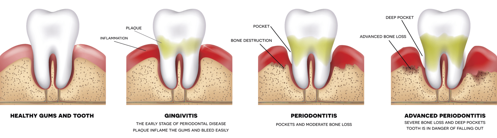 gum disease treatment infographic