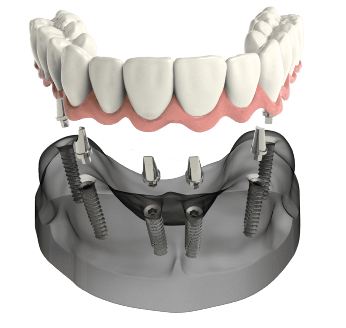 All-on-four dental implants in Virginia Beach, Virginia