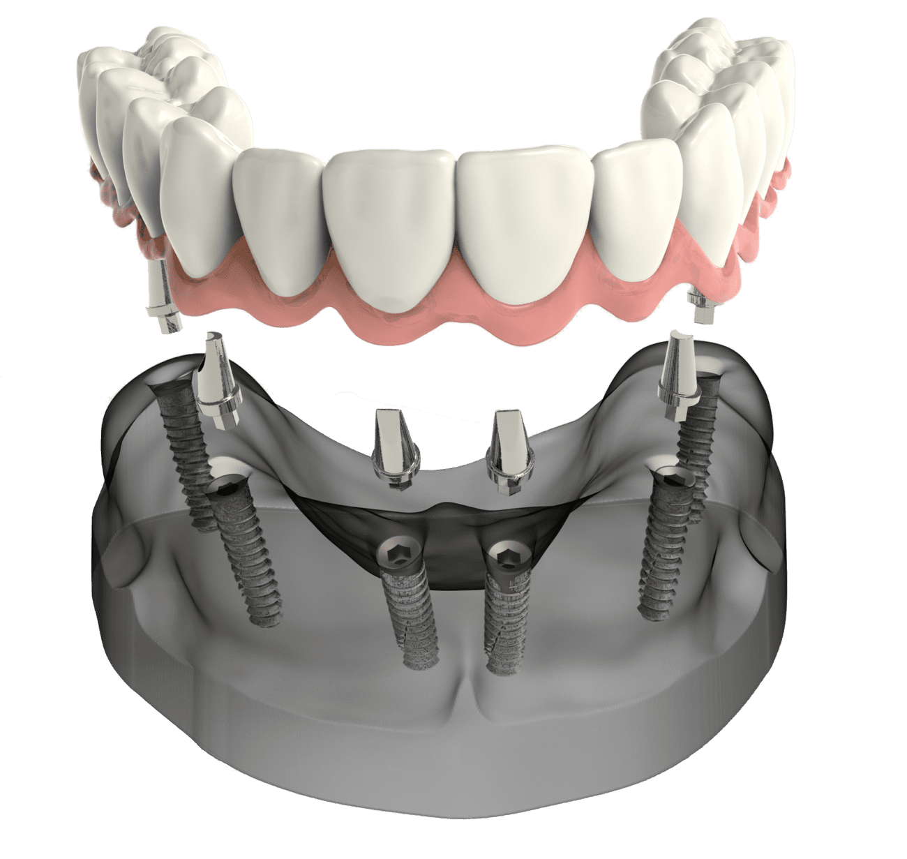 All-on-4 Dental Implants | Virginia Beach, VA All-on-4 Dental Implants | Virginia Beach, VA