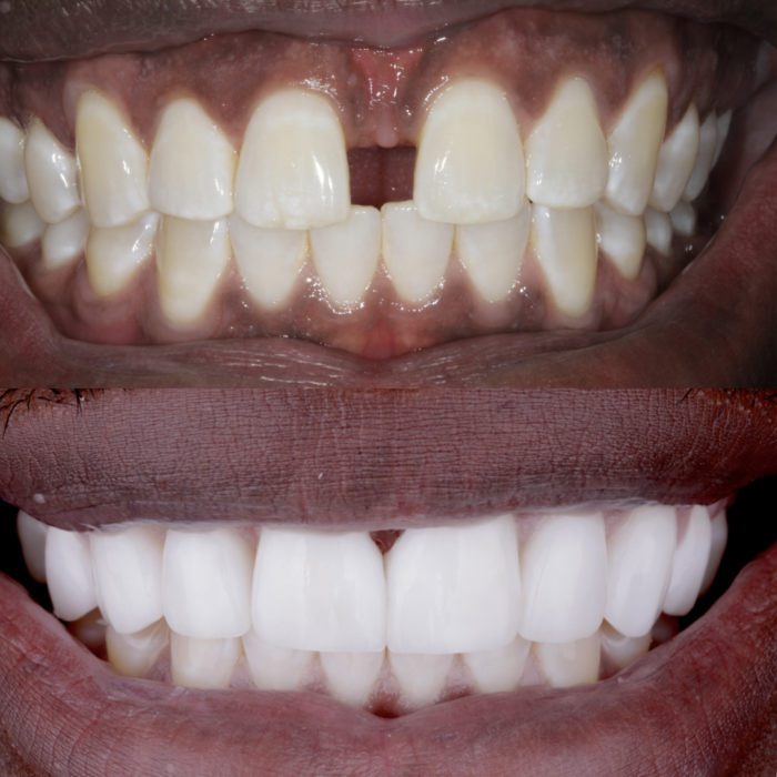 Porcelain veneers results for gaps between teeth