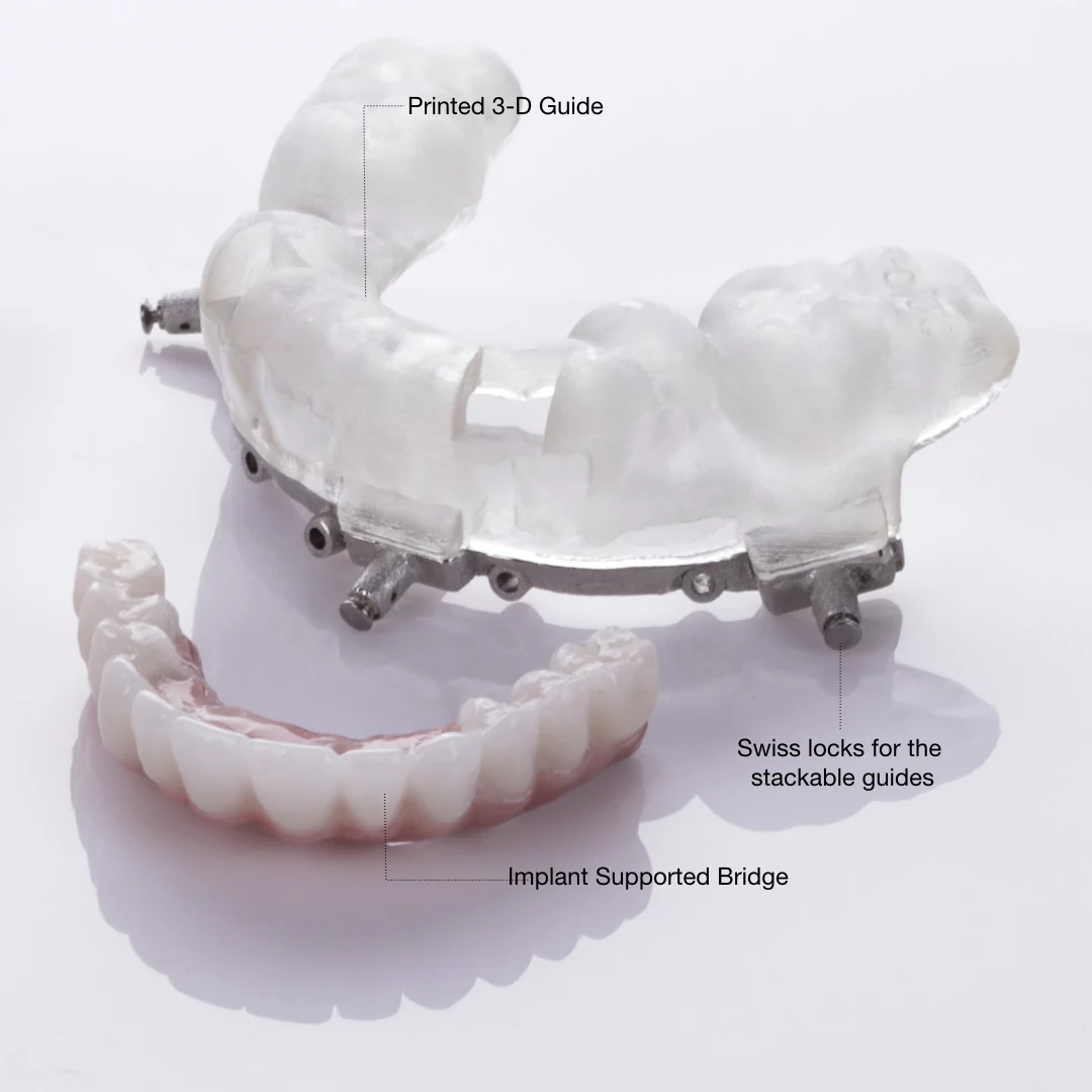 Teeth in a day in Virginia Beach, Virginia