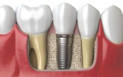 Affordable dental implants in Virginia Beach, Virginia