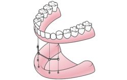 all on four dental implants in suffolk, virginia