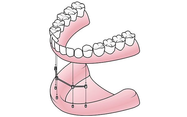 Implant Dentures by dentist in Virginia Beach VA