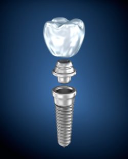 Treatment Options That Use Dental Implants