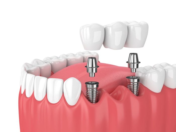 multiple dental implants in Virginia Beach, Virginia