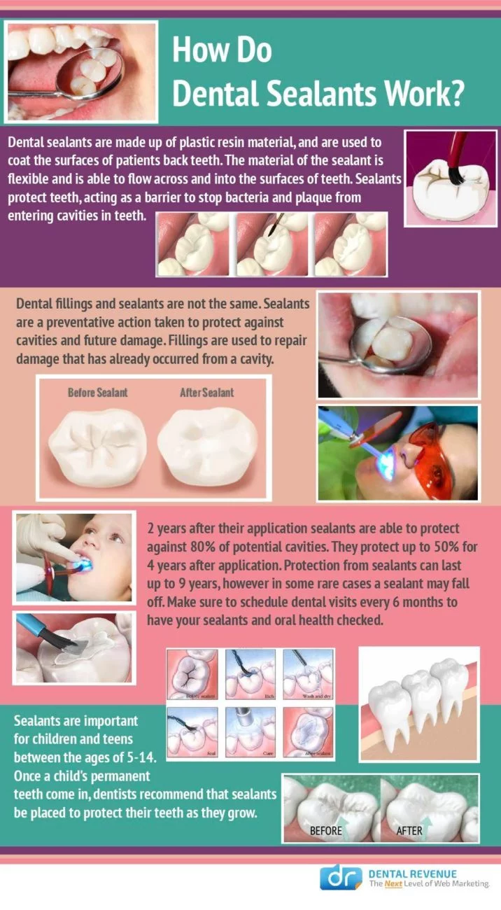 How dental sealants work infographic