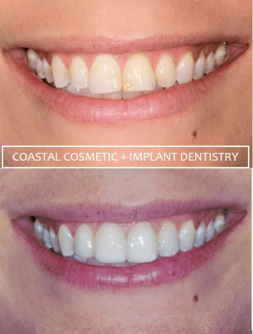 Before and after dental services at Coastal Cosmetic & Implant Dentistry