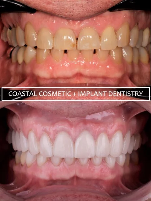 Before and after dental services at Coastal Cosmetic & Implant Dentistry