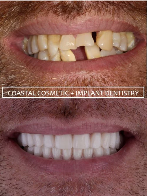 Before and after dental services at Coastal Cosmetic & Implant Dentistry
