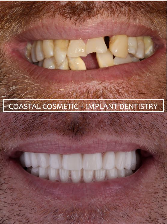Dental patient before and after dental implants