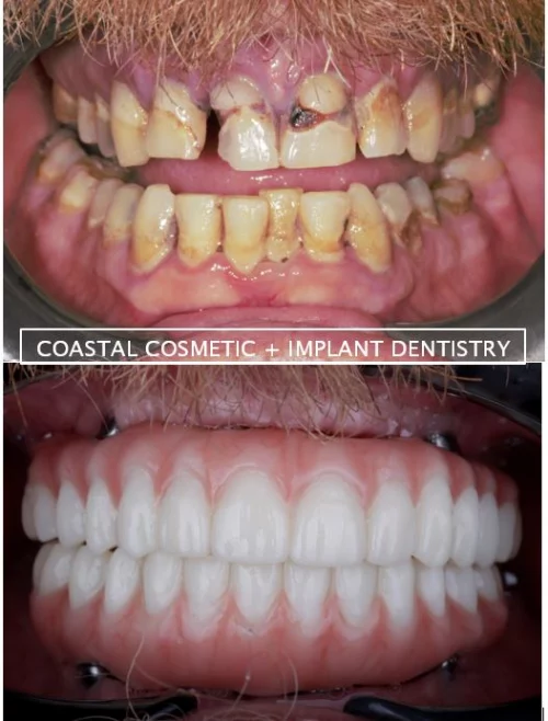 Before and after dental services at Coastal Cosmetic & Implant Dentistry
