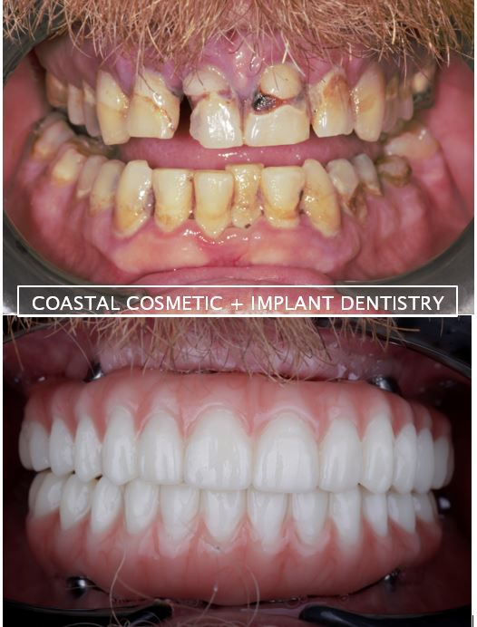 Before and after all-on-four implant dentures