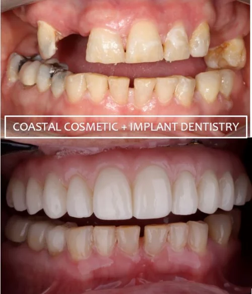 Before and after dental services at Coastal Cosmetic & Implant Dentistry