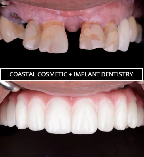 Before and after dental services at Coastal Cosmetic & Implant Dentistry