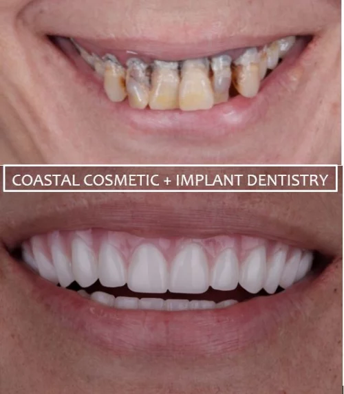 Before and after dental services at Coastal Cosmetic & Implant Dentistry