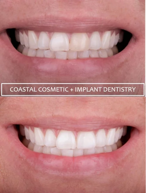 Before and after dental services at Coastal Cosmetic & Implant Dentistry