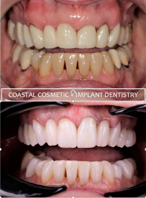 Before and after dental services at Coastal Cosmetic & Implant Dentistry