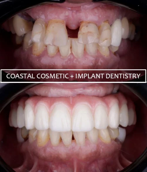 Before and after dental services at Coastal Cosmetic & Implant Dentistry