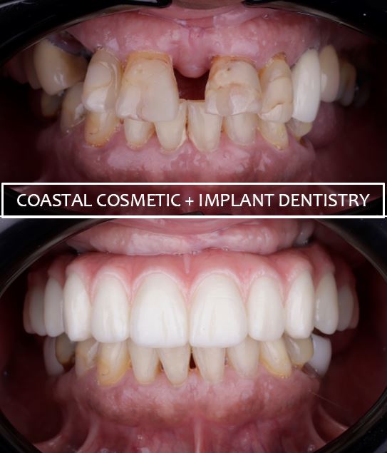 Dental patient before and after replacing missing teeth