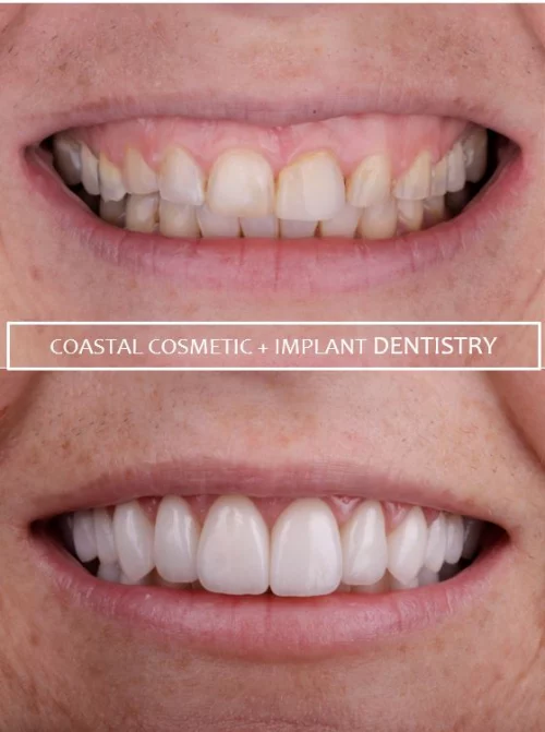 Before and after dental services at Coastal Cosmetic & Implant Dentistry