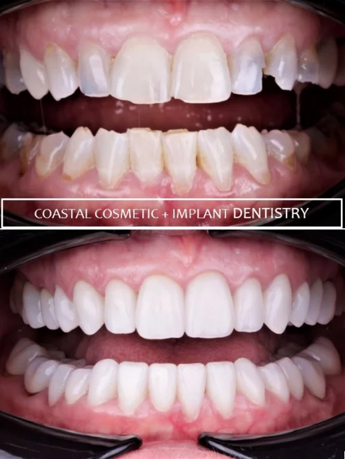 Before and after dental services at Coastal Cosmetic & Implant Dentistry