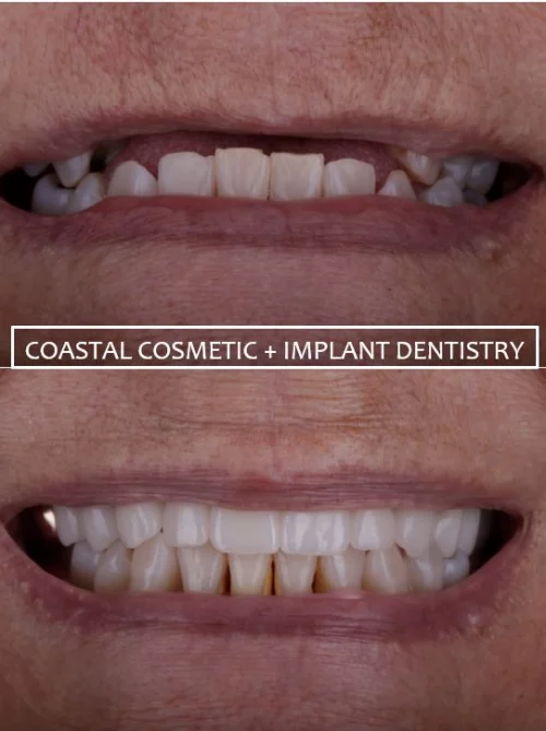Results from dentistry at Coastal Cosmetic & Implant Dentistry