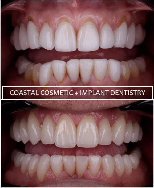 Before and after dental services at Coastal Cosmetic & Implant Dentistry