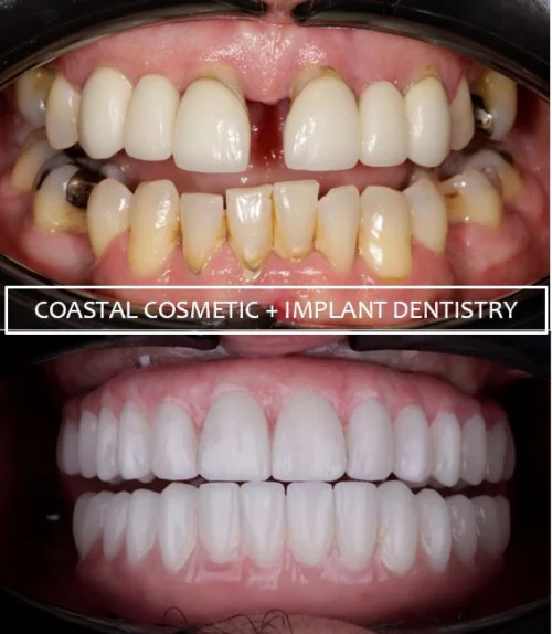 Before and after dental services at Coastal Cosmetic & Implant Dentistry