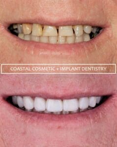 Before and after preventive dental care