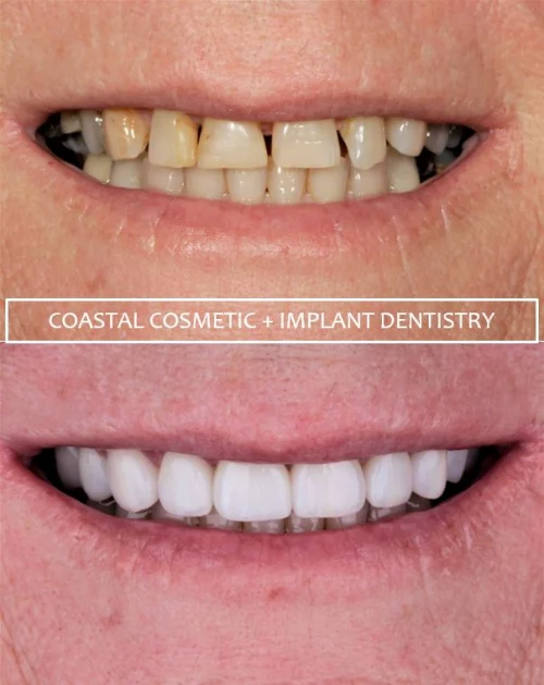 Before and after dental services at Coastal Cosmetic & Implant Dentistry