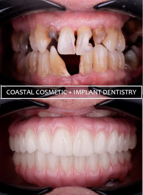 Before and after dental services at Coastal Cosmetic & Implant Dentistry