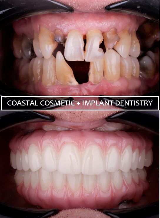 Patient before and after restorative dentistry