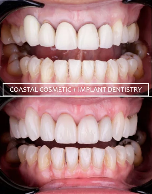Before and after dental services at Coastal Cosmetic & Implant Dentistry