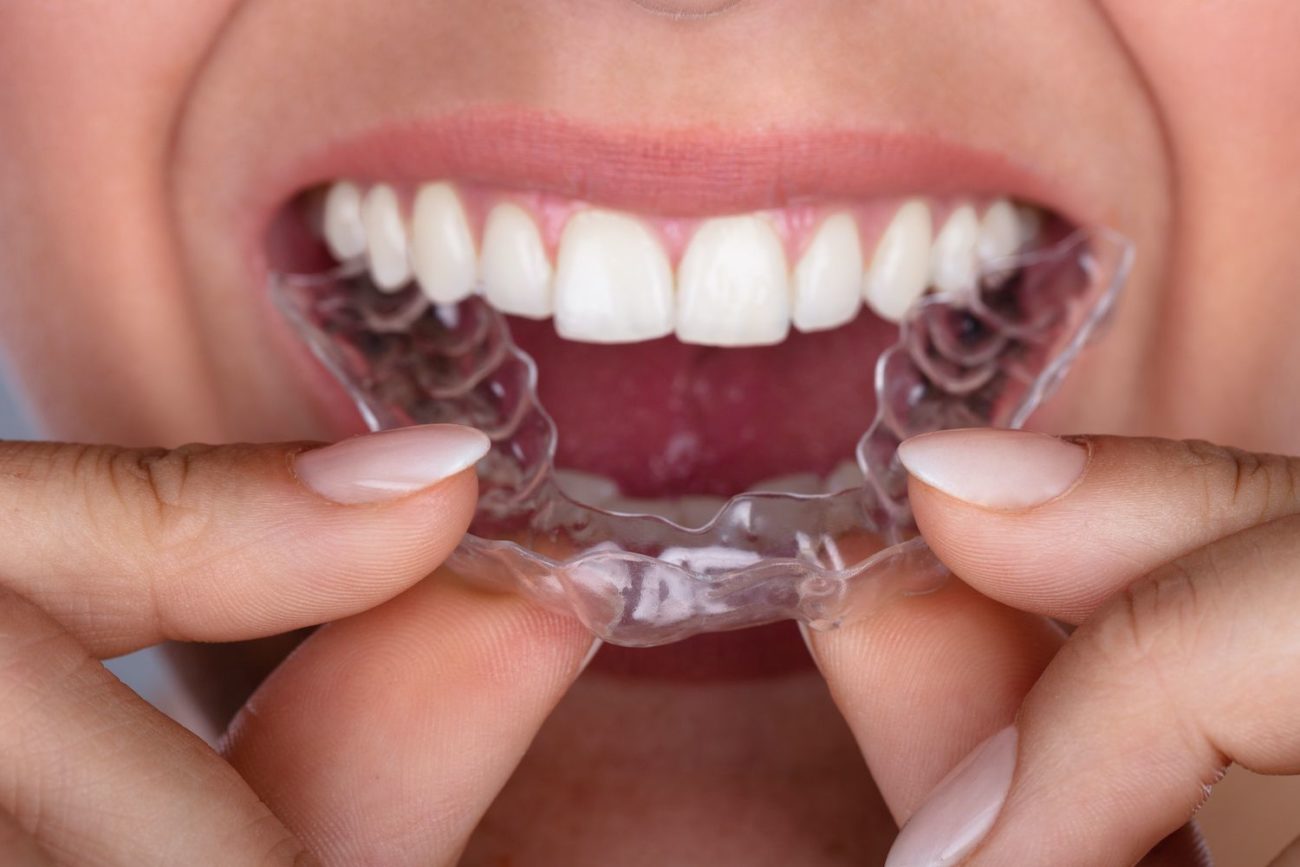 Why Patients Prefer Clear Aligners