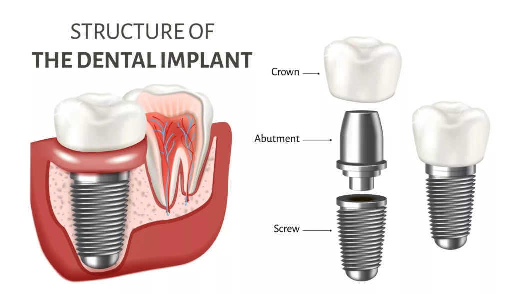 visual structure of a dental implant