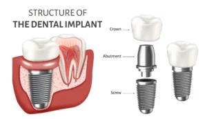 visual structure of a dental implant - crown abutment screw restorative dentistry dentist in Virginia Beach Virginia
