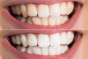 Close-up image of teeth before and after a whitening treatment dentist in Virginia Beach Virginia