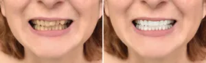 comparison of a woman's smile before and after a whitening treatment and teeth correction discolored teeth cosmetic dentistry dentist in Virginia Beach Virginia