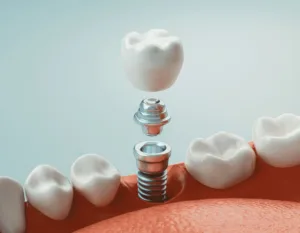 3D render of the individual pieces of a dental implant floating above a jaw dental implant restorative dentistry dentist in Virginia Beach Virginia