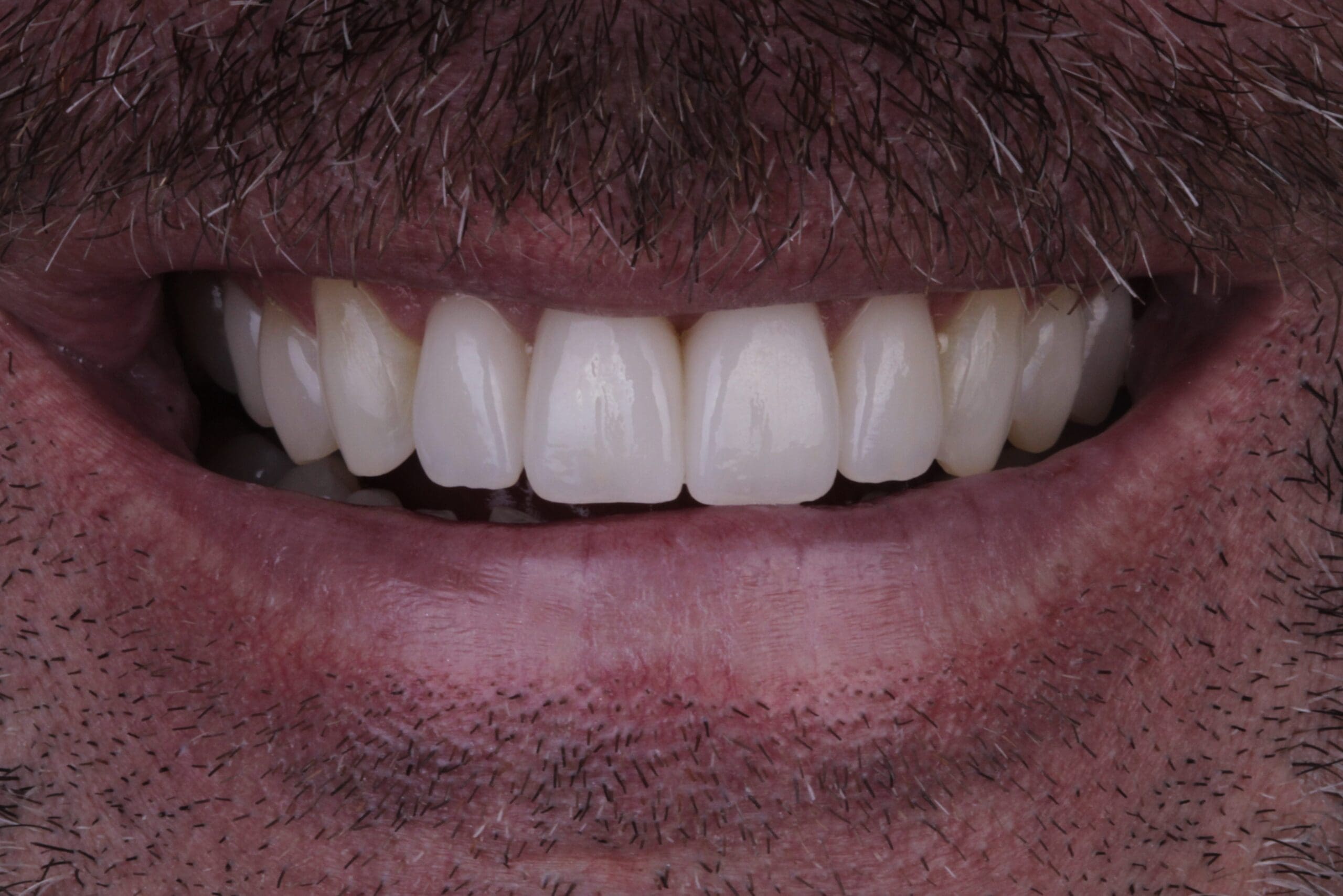 After cosmetic dentistry
