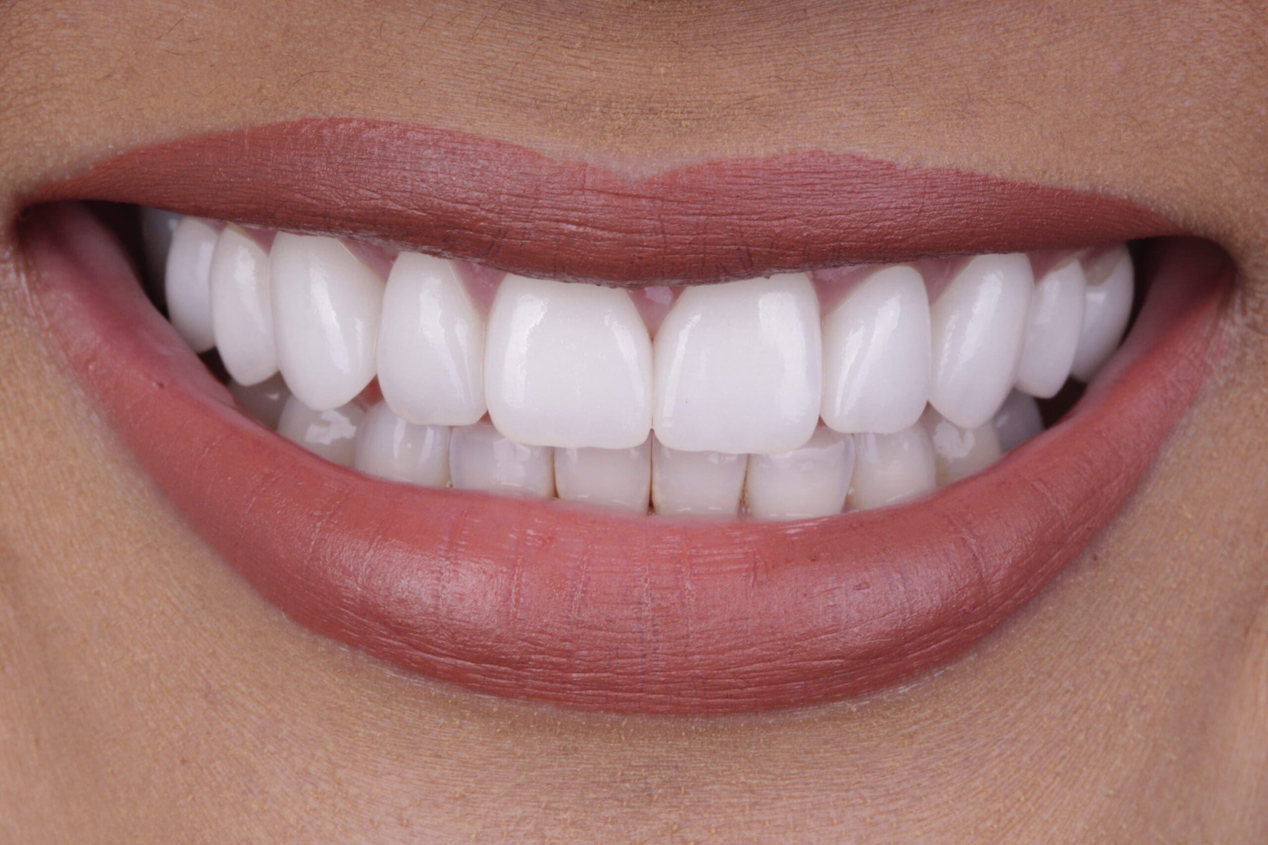 After cosmetic dentistry