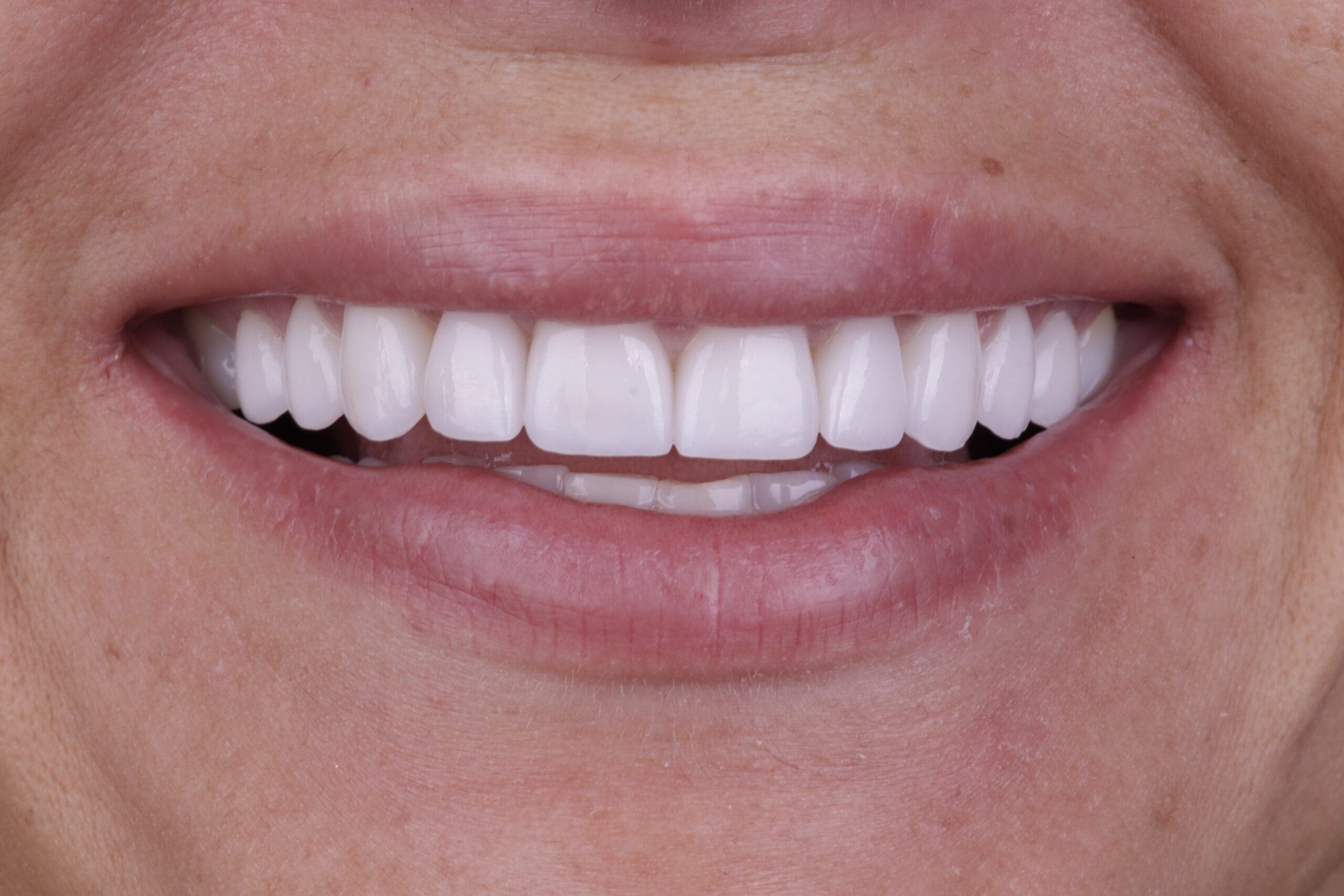 After cosmetic dentistry
