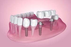 Missing Teeth can lead to worsening dental conditions without treatment