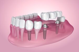 Missing Teeth can lead to worsening dental conditions without treatment