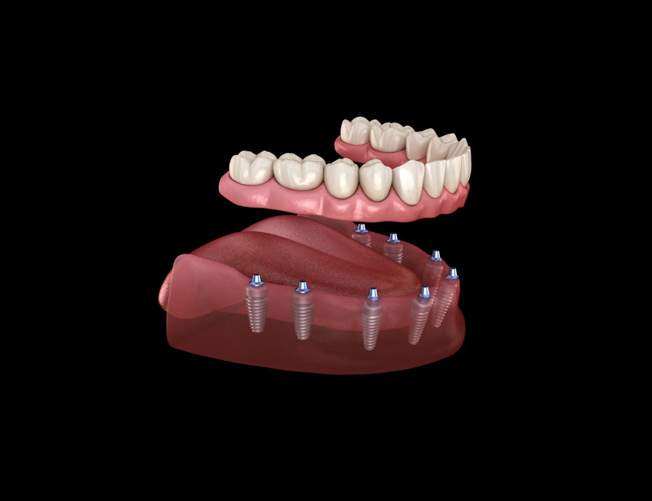 All-on-X dental implants