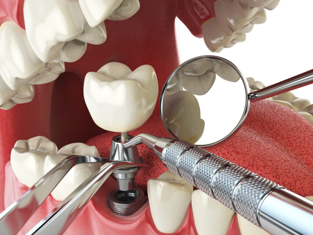 The Benefits of Dental Implants Under One Roof