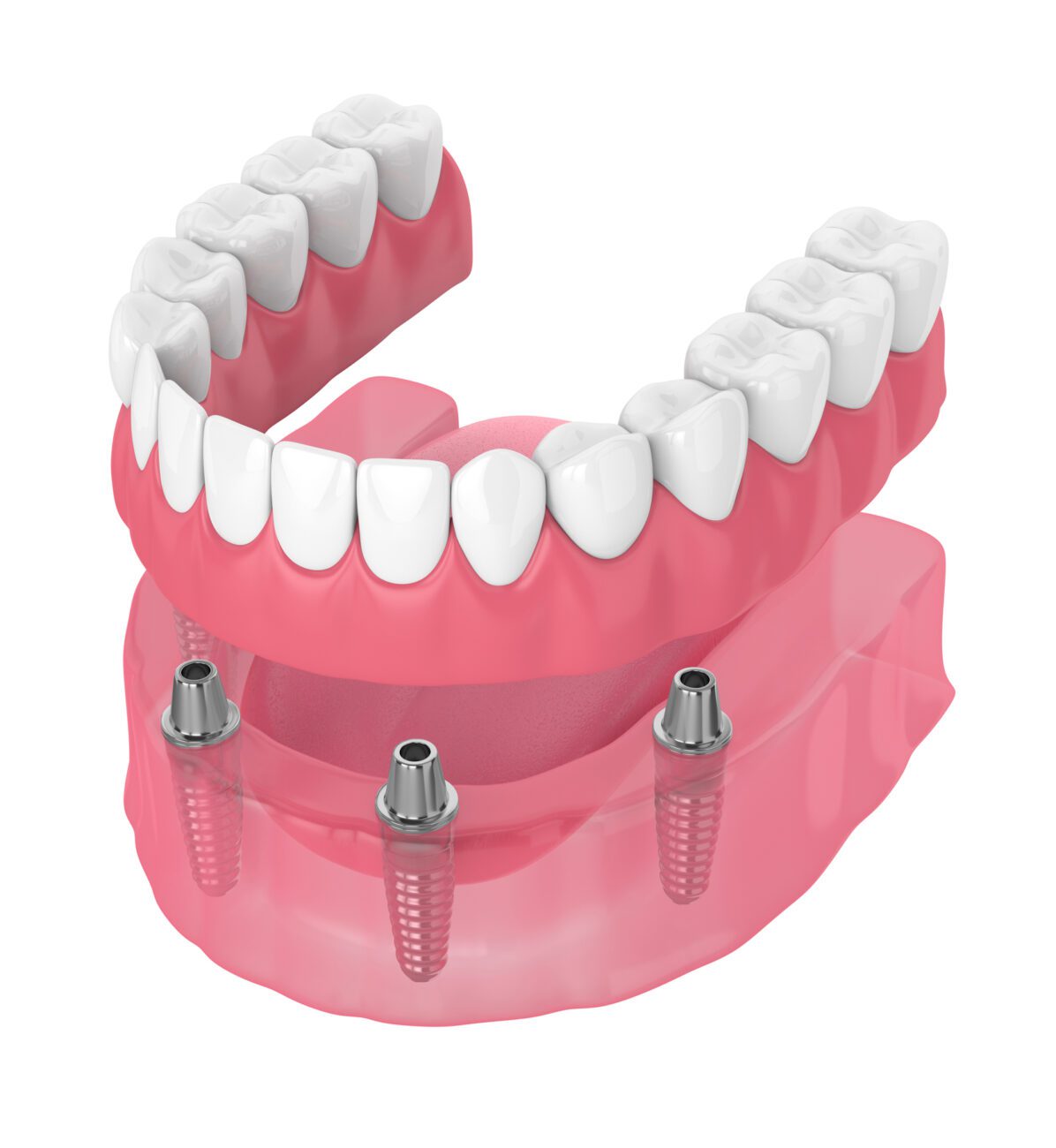 All on four implants can be an ideal solution for significant tooth loss, advanced gum disease, or those looking to move on from dentures.