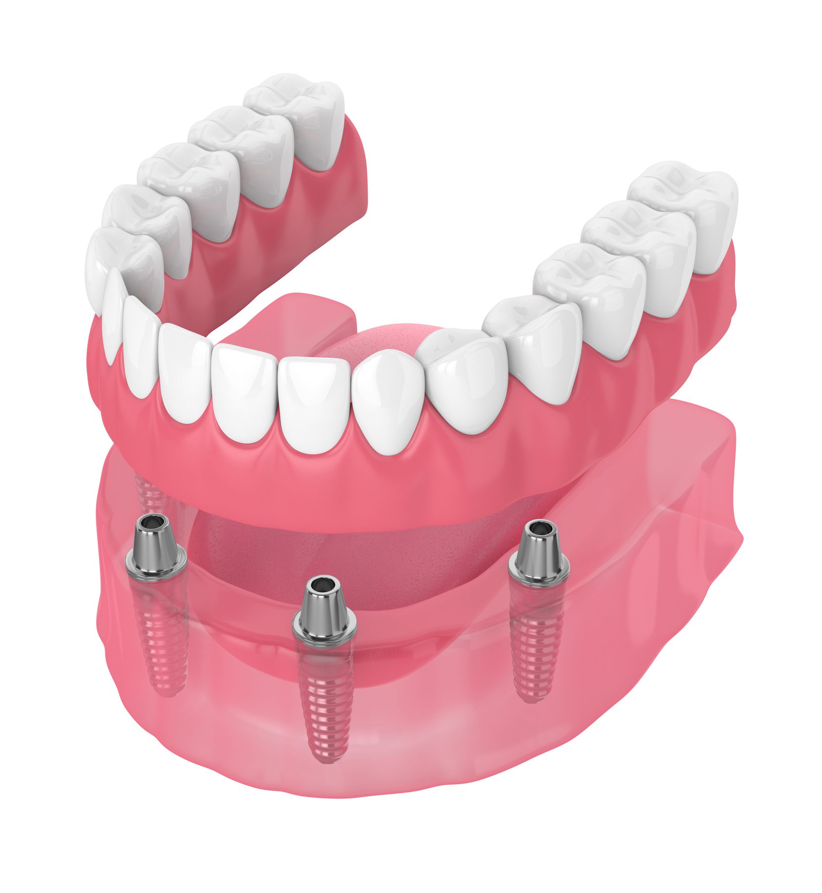 All-On-4 dental implants in Virginia Beach